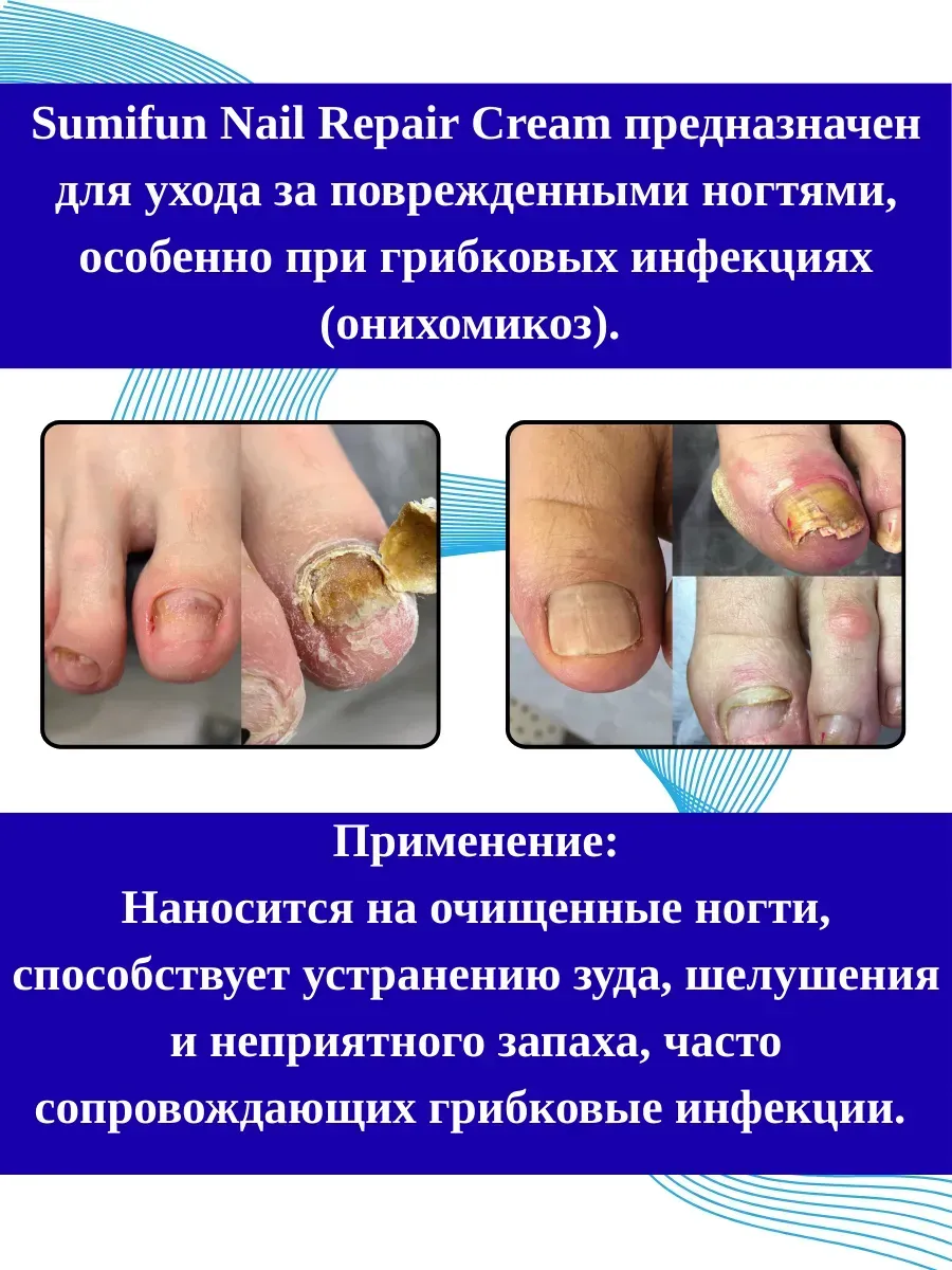 картинка Противогрибковое средство от грибка ногтей 20г от магазина Одежда+