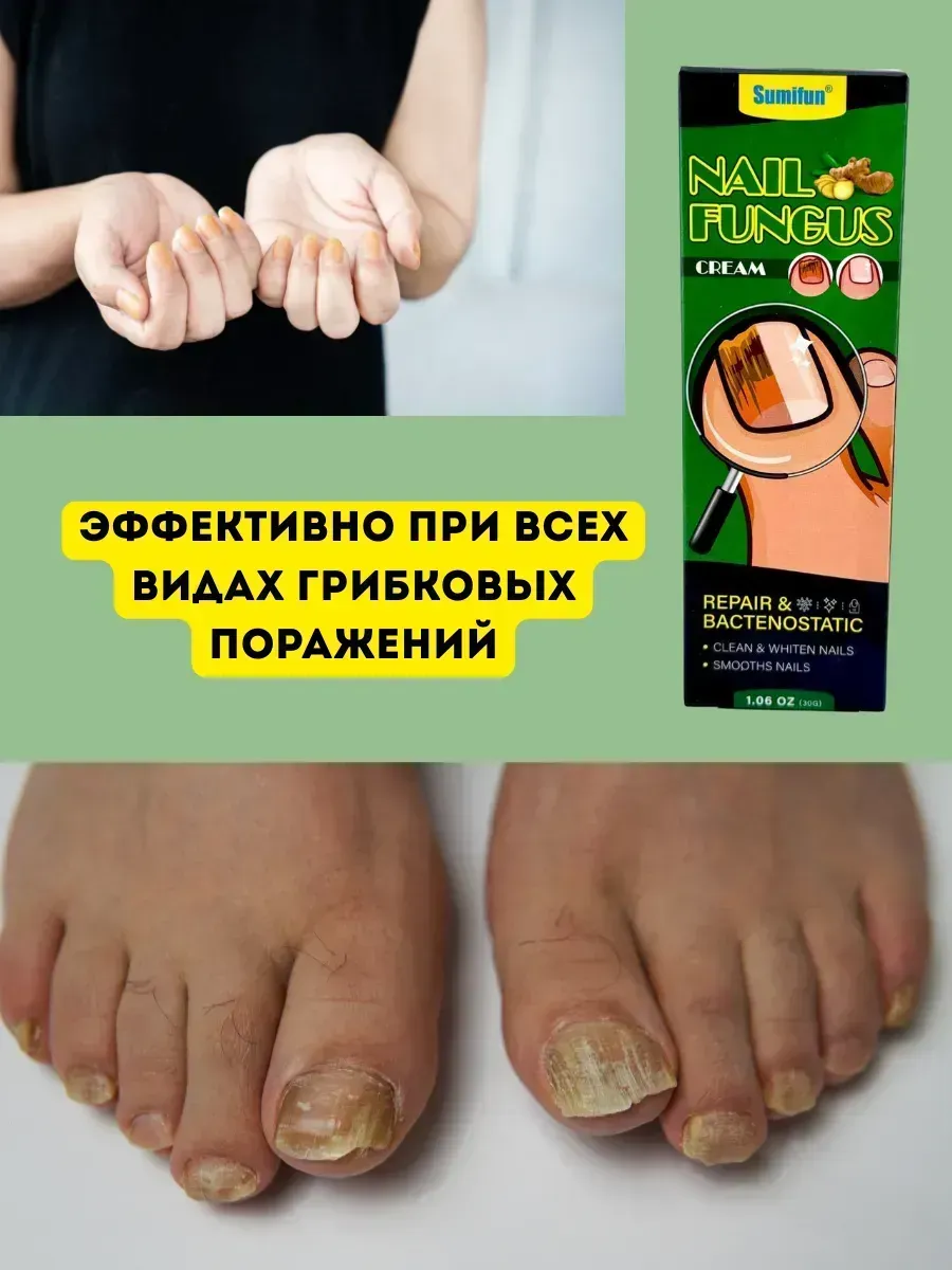 картинка Крем от грибка ногтей и кожи между пальцев от магазина Одежда+