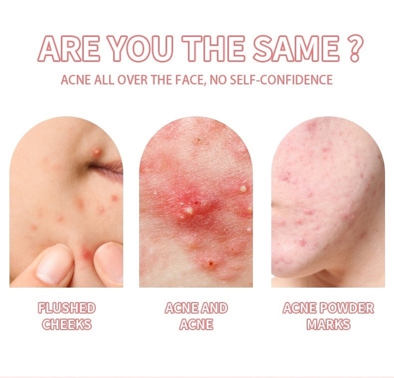 картинка MOOYAM Патчи от прыщей от магазина Одежда+