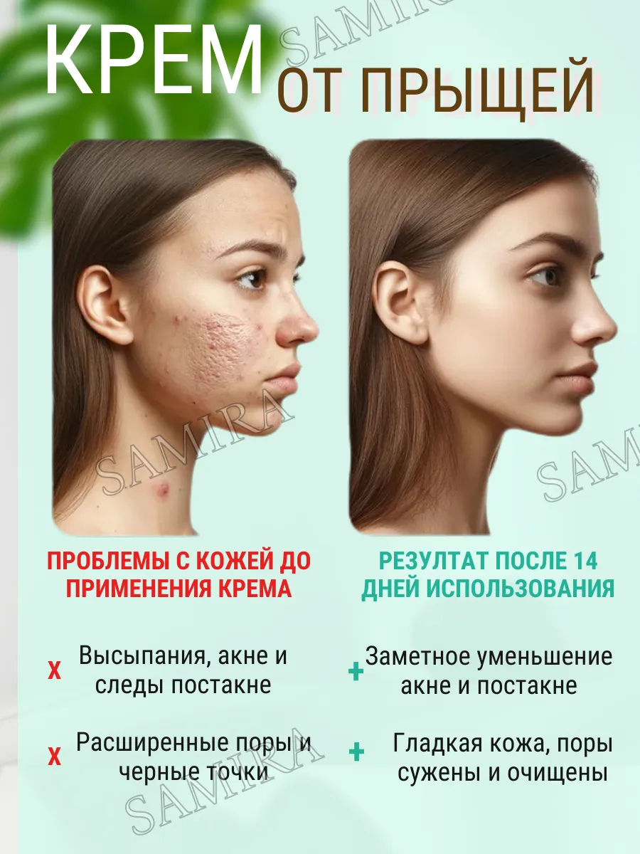 картинка Антибактериальный крем от прыщей на лице от магазина Одежда+